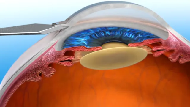 Cross-section illustration of the eye showing the natural lens inside the capsule