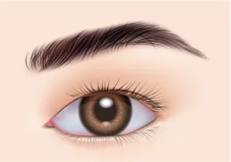 Illustration of a clear intraocular lens and open capsule after laser treatment for secondary cataract