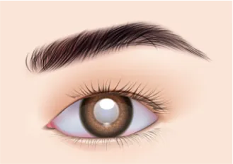 Illustration of an eye with posterior capsule opacification causing cloudy vision after cataract surgery