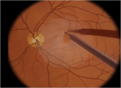 Surgical instrument peeling a membrane from the retinal surface during epiretinal membrane surgery