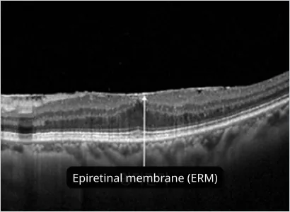 OCT scan of the retina with the epiretinal membrane marked on its surface