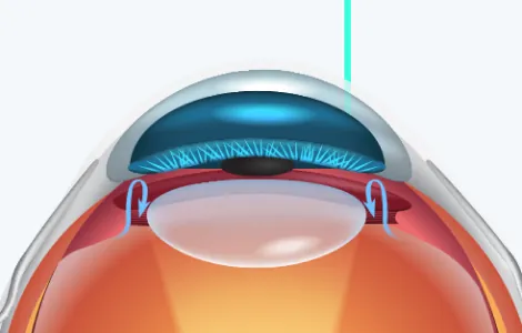 Diagram of laser treatment on the iris and drainage angle of the eye for glaucoma