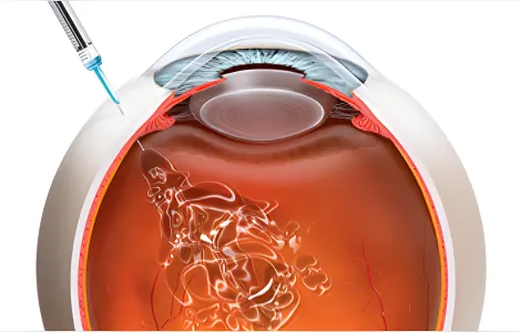 Illustration of an anti-VEGF injection into the eye for wet macular degeneration treatment