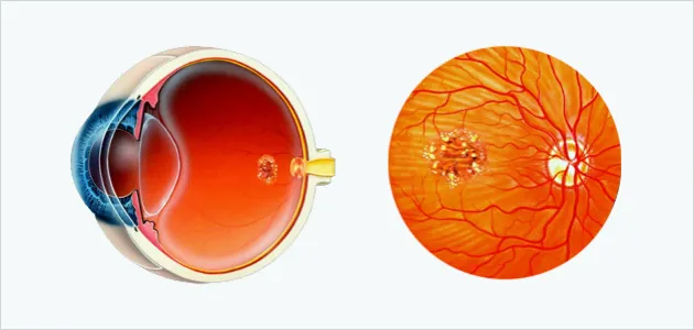 Illustration of an eye and a fundus view showing macular changes in macular degeneration