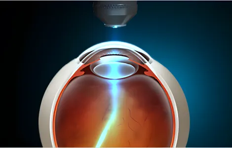 Illustration of photodynamic laser treatment targeting abnormal vessels beneath the macula