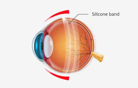 Diagram of scleral buckling with a silicone band around the eye to repair retinal detachment