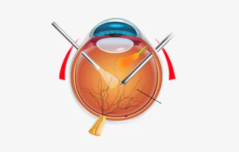 Diagram of vitrectomy instruments inside the eye during retinal detachment surgery