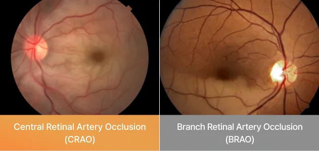 Fundus photographs of central and branch retinal artery occlusion