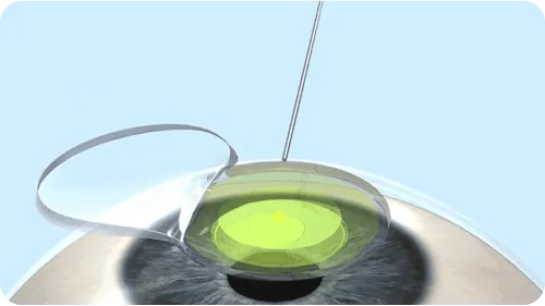 Illustration of riboflavin solution being applied to the cornea during cross-linking