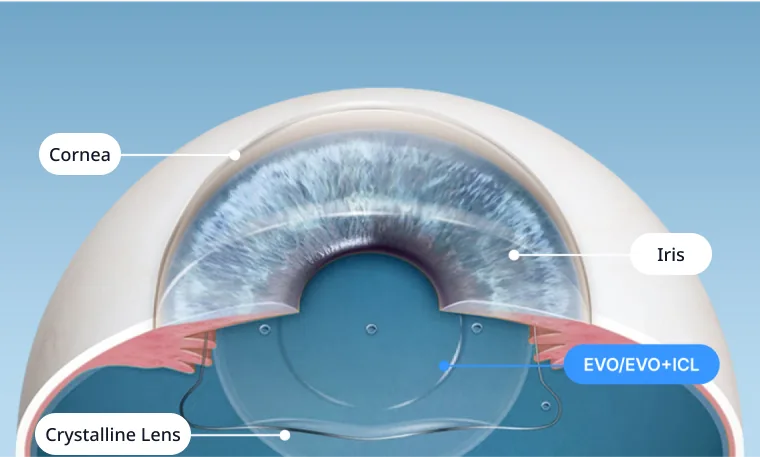 Cross-section showing an EVO ICL lens sitting between the iris and the natural lens