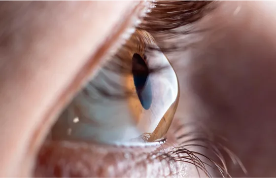 Side view of an eye showing the cornea bulging forward in a cone shape