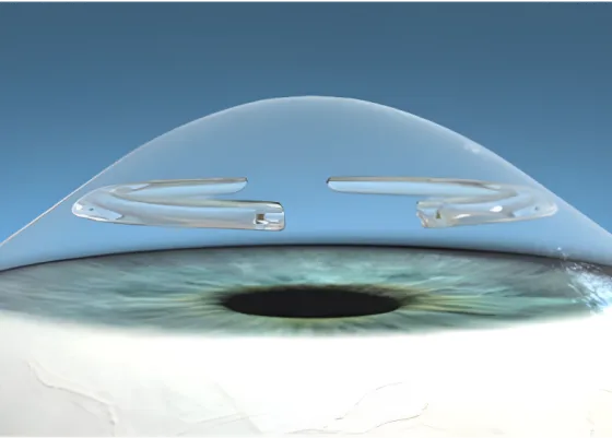 Diagram of two corneal ring segments implanted in a bulging cornea to flatten it
