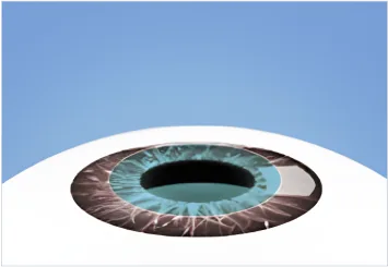 Diagram of a protective lens placed over the cornea after LASEK laser treatment
