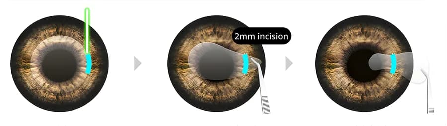 Three-step diagram of a 2mm micro-incision on the cornea during New SMILE LASIK