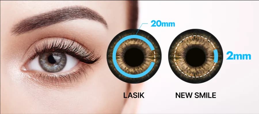 Diagram comparing a 20mm LASIK flap opening with the 2mm New SMILE LASIK incision