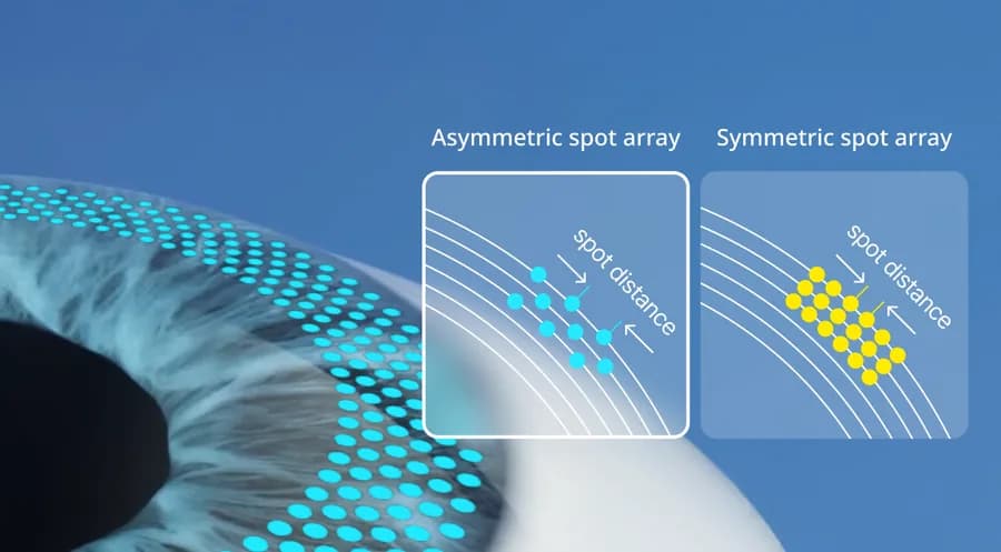 Diagram comparing asymmetric and symmetric laser spot arrays on the cornea