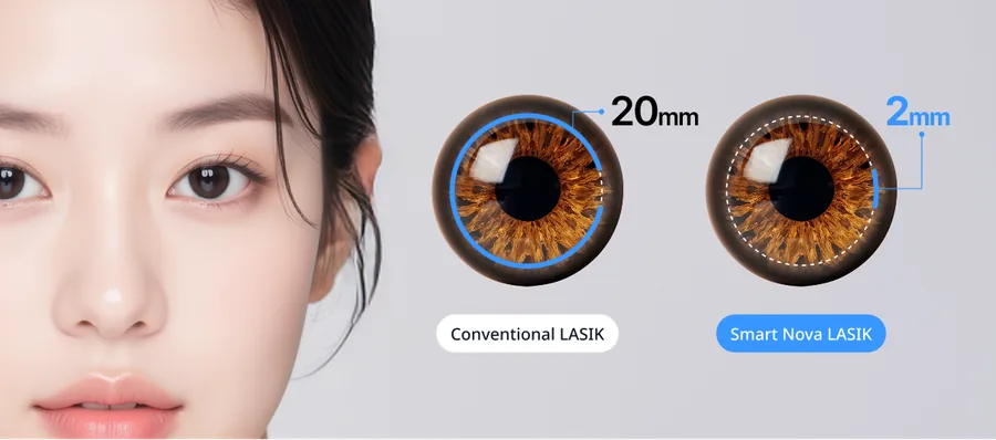 Comparison of a conventional LASIK flap opening with the 2mm Smart Nova LASIK incision